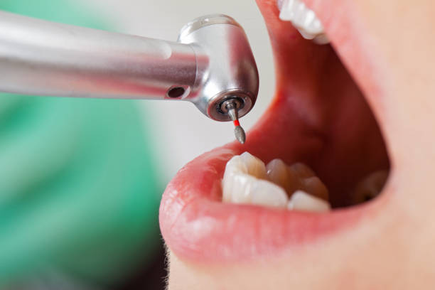 Emergency Dental Filling Replacement in MO